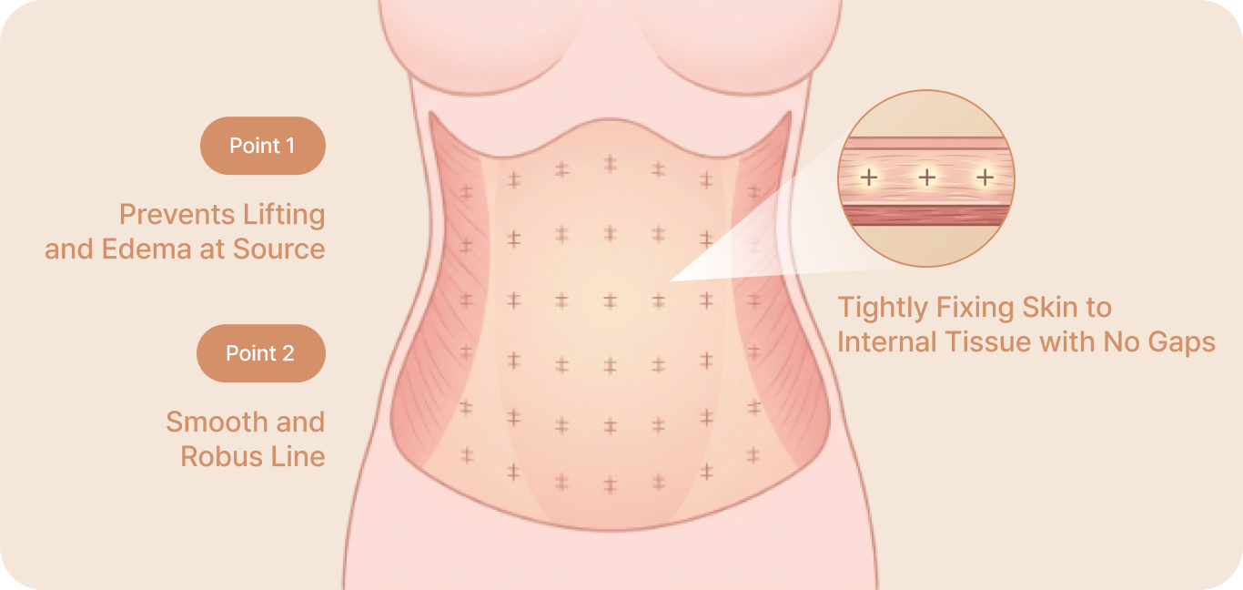id Hospital - Tummy Tuck - Seamless Adhesion
