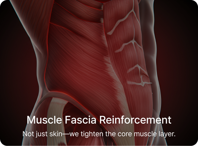 id Hospital - Tummy Tuck - Muscle Fascia Reinforcement