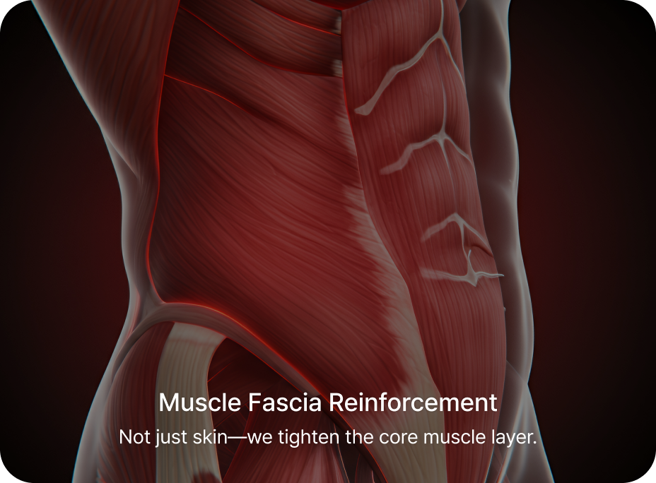 id Hospital - Tummy Tuck - Muscle Fascia Reinforcement