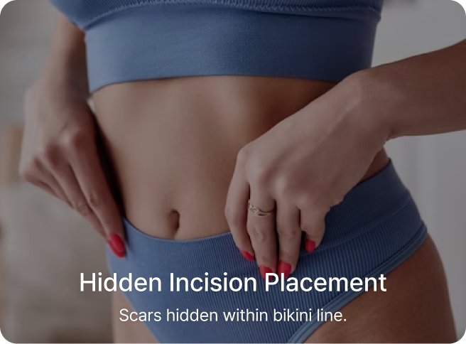 id Hospital - Tummy Tuck - Hidden Incision Placement