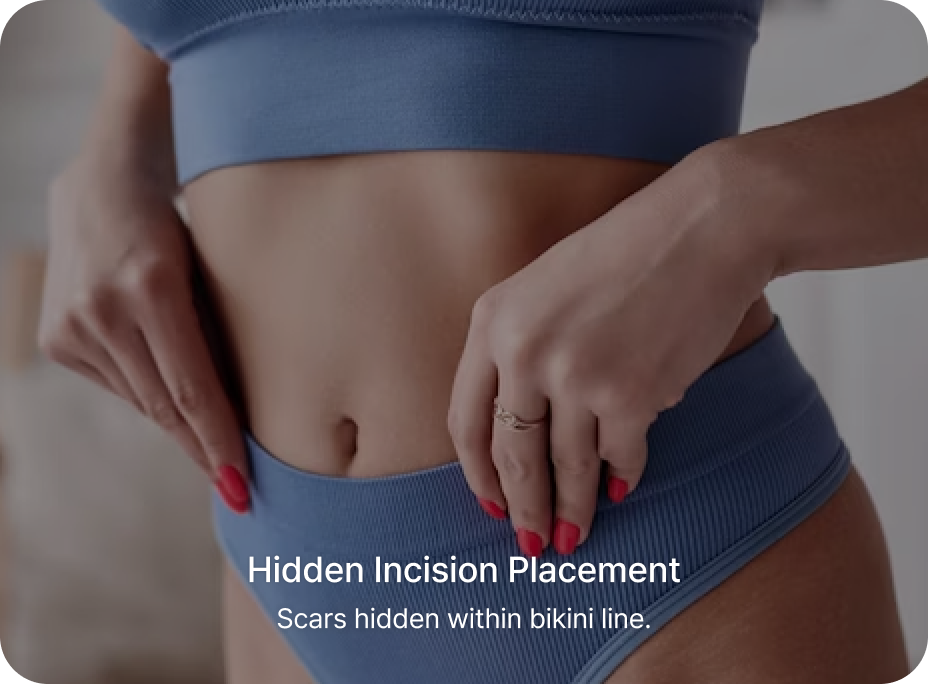 id Hospital - Tummy Tuck - Hidden Incision Placement