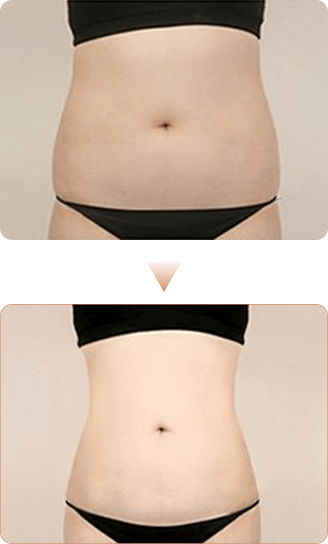 id Hospital - Liposuction - Maximum Liposuction Overview