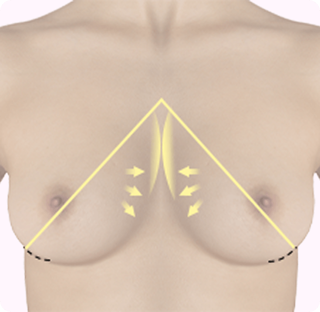 id Hospital - Breast Augmentation - Peach (U-line) Incision Method