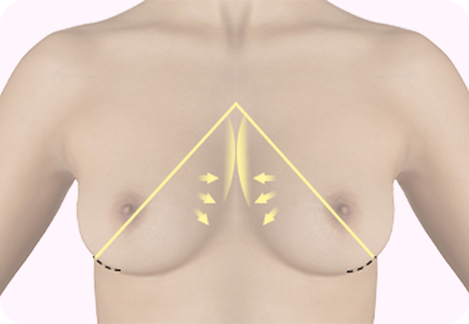 id Hospital - Breast Augmentation - Peach (U-line) Incision Method