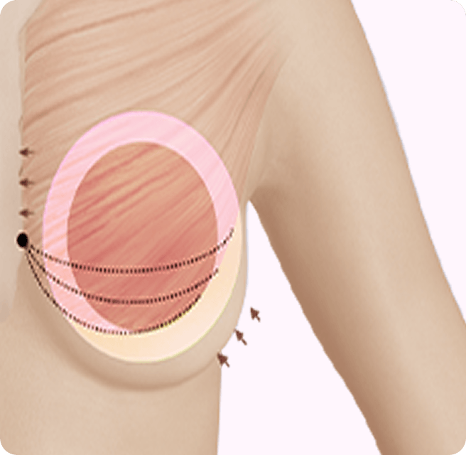 id Hospital - Breast Augmentation - 360 Degree Precision Dissection