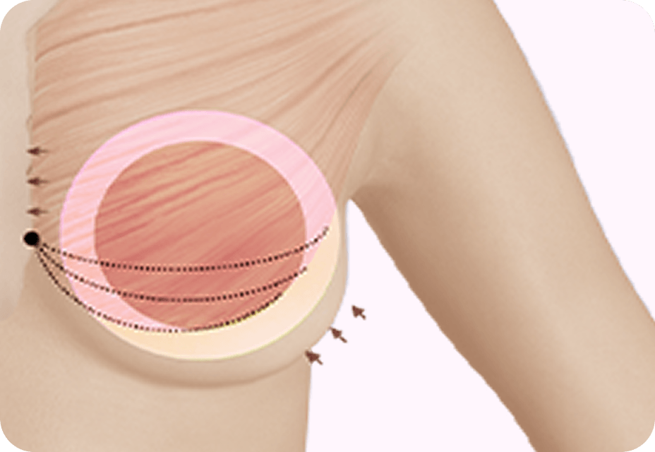id Hospital - Breast Augmentation - 360 Degree Precision Dissection