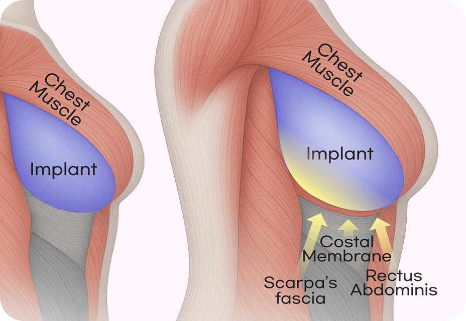 id Hospital - Breast Augmentation - Triple Tightening Technique