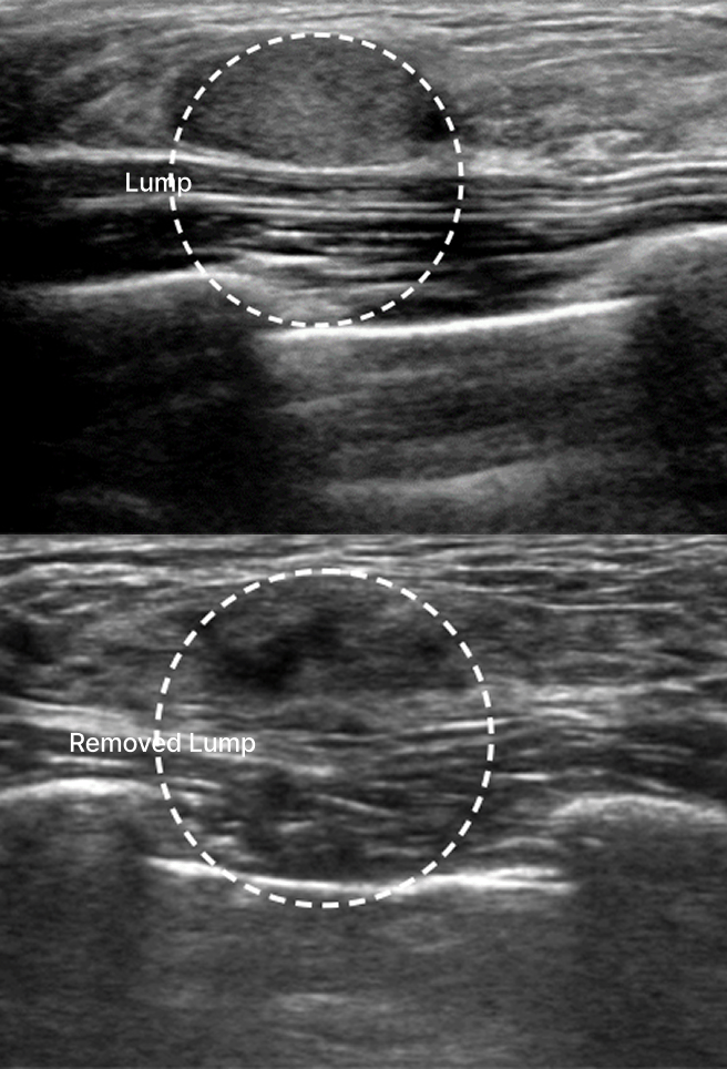 id Hospital - Breast Examination Center - Mammotome Before and After Lump Removal
