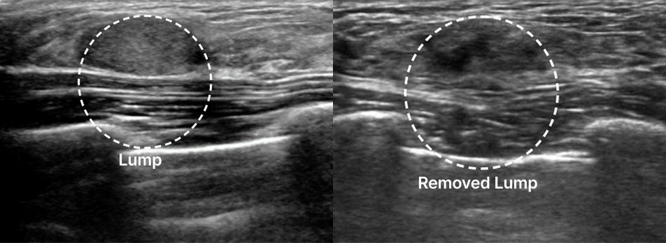 id Hospital - Breast Examination Center - Mammotome Before and After Lump Removal