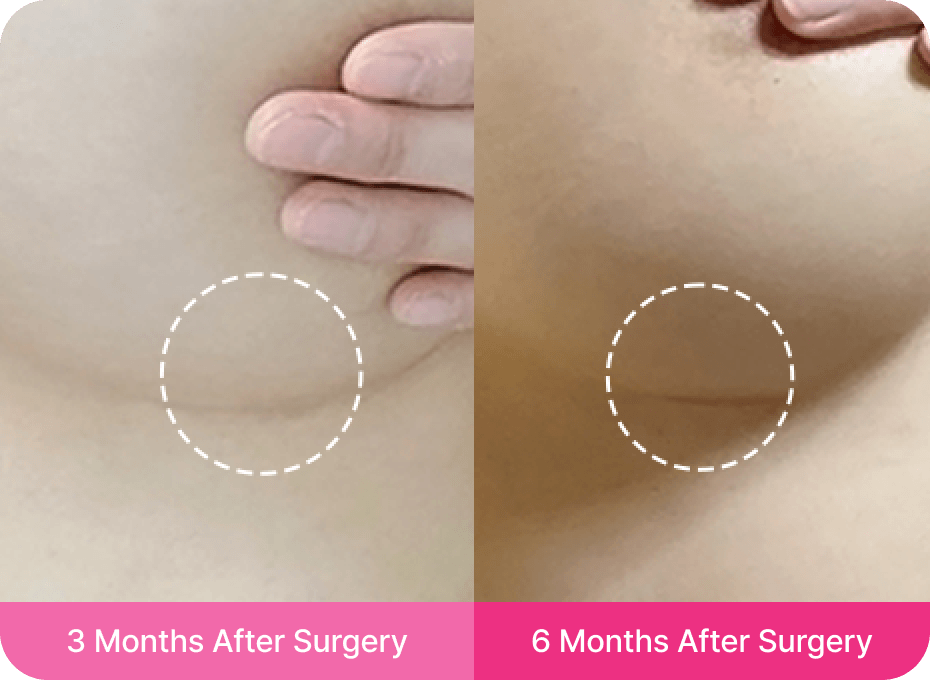 id Hospital - Breast Reduction - Minimized Scarring