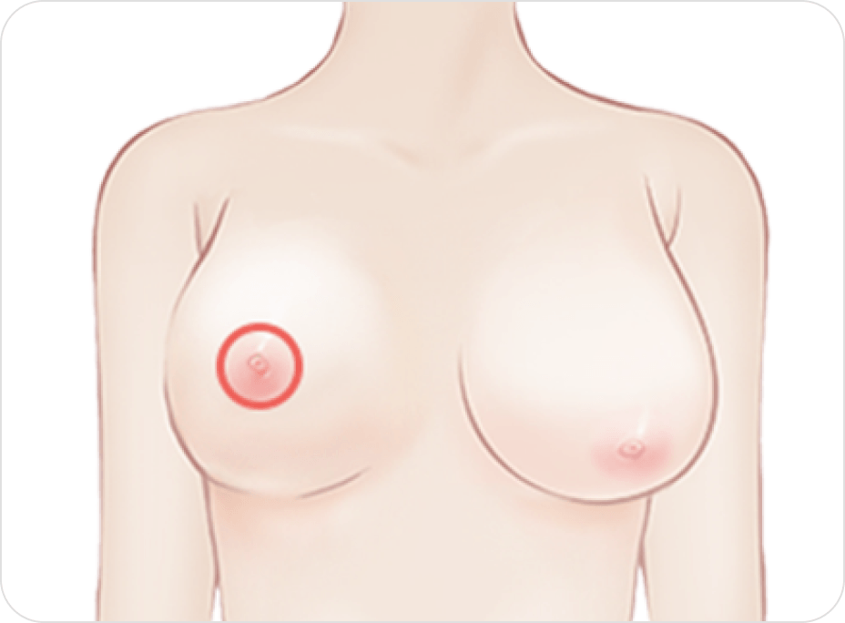 id Hospital - Breast Reduction - Areolar Incision