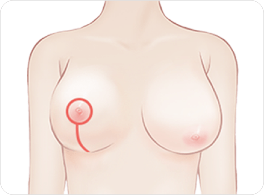id Hospital - Breast Reduction - Vertical Incision