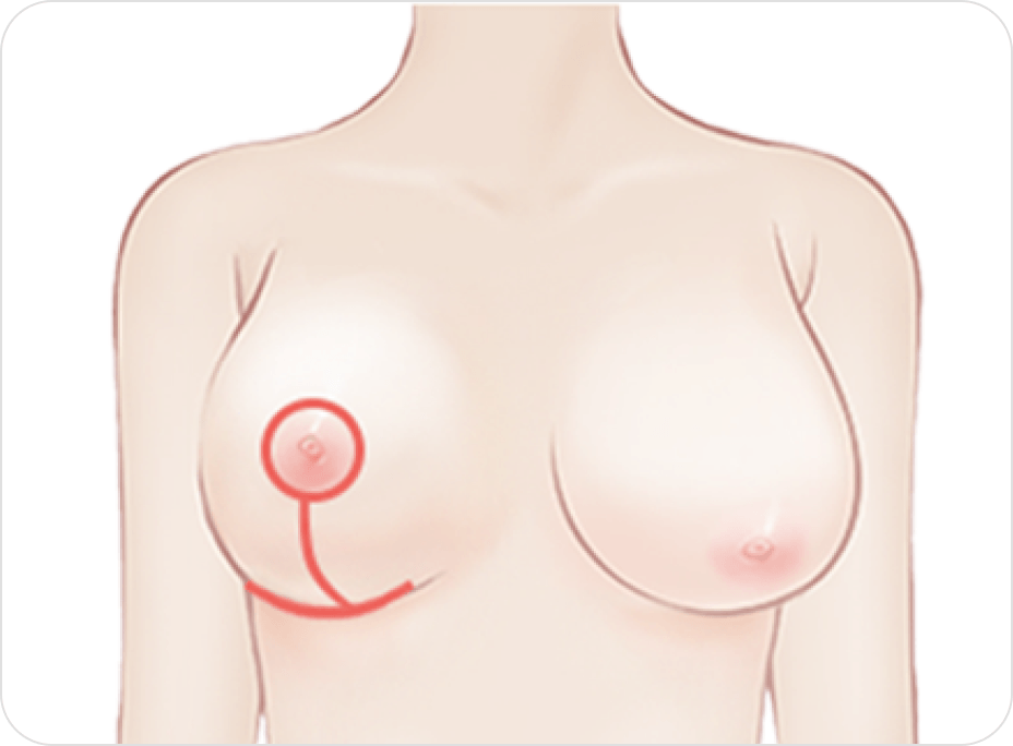id Hospital - Breast Reduction - Inverted T Incision