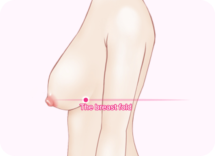 id Hospital - Breast Lifting - Stage 2