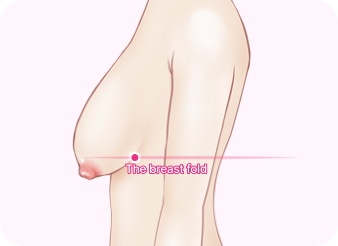 id Hospital - Breast Lifting - Stage 3