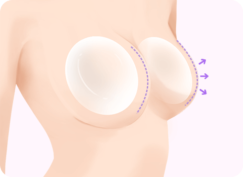 id Hospital - Breast Lifting - Implant Breast Augmentation