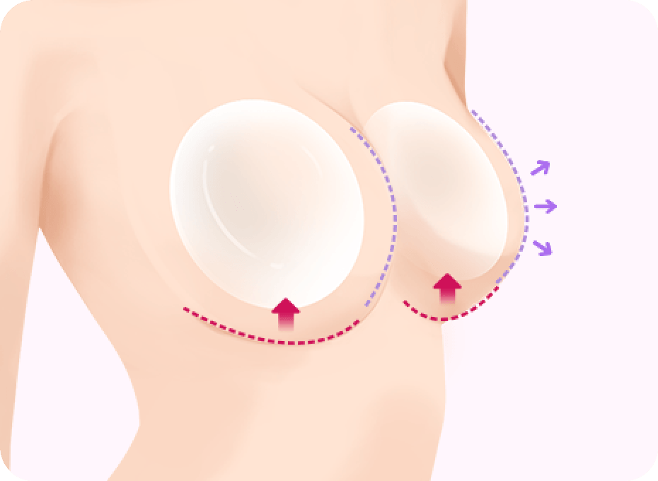 id Hospital - Breast Lifting - Mastopexy and Implant Breast Augmentation