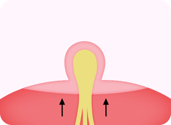 id Hospital - Nipple Correction - Step 2