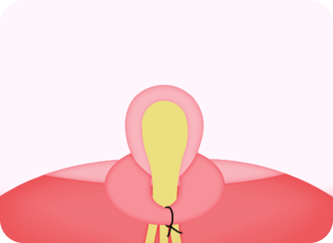 id Hospital - Nipple Correction - Step 3
