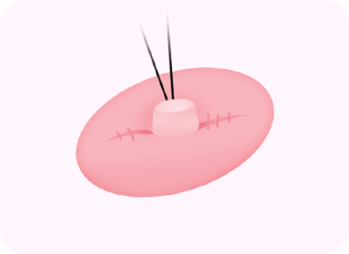 id Hospital - Nipple Correction - Step 4