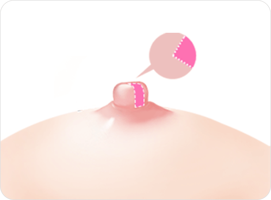 id Hospital - Nipple Correction - Long Nipple Reduction Before
