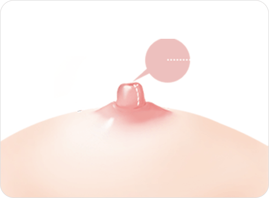 id Hospital - Nipple Correction - Long Nipple Reduction After