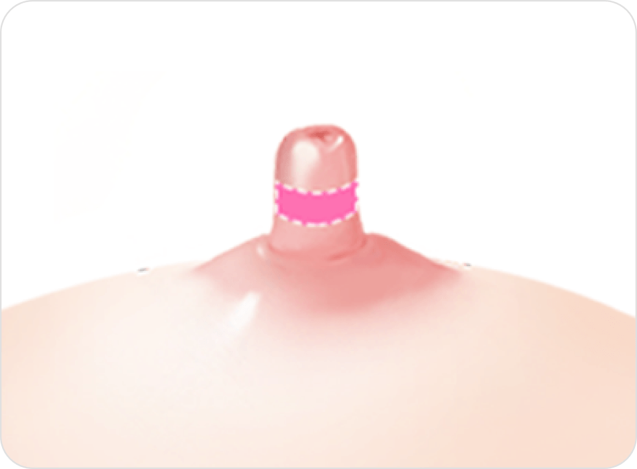 id Hospital - Nipple Correction - Long Nipple Reduction Step 1
