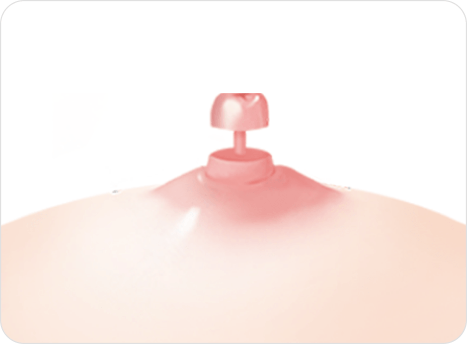 id Hospital - Nipple Correction - Long Nipple Reduction Step 2