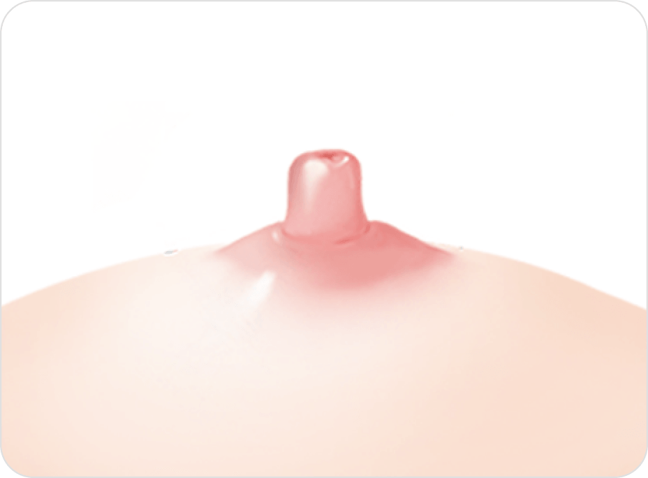 id Hospital - Nipple Correction - Long Nipple Reduction Step 3