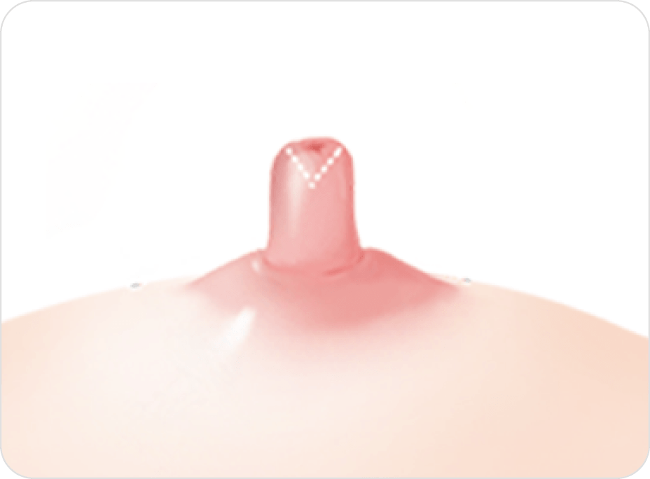 id Hospital - Nipple Correction - Non-Duct-Preserving Method Step 1