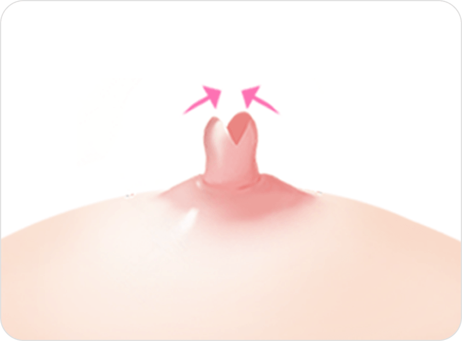 id Hospital - Nipple Correction - Non-Duct-Preserving Method Step 2