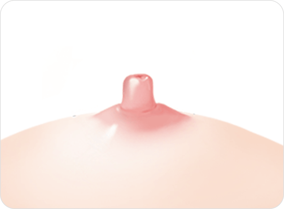 id Hospital - Nipple Correction - Non-Duct-Preserving Method Step 3