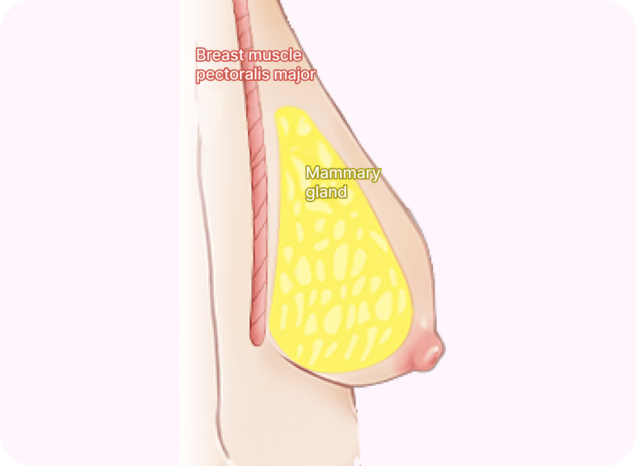 id Hospital - Breast Augmentation After Delivery - Saggy Breast Before Surgery