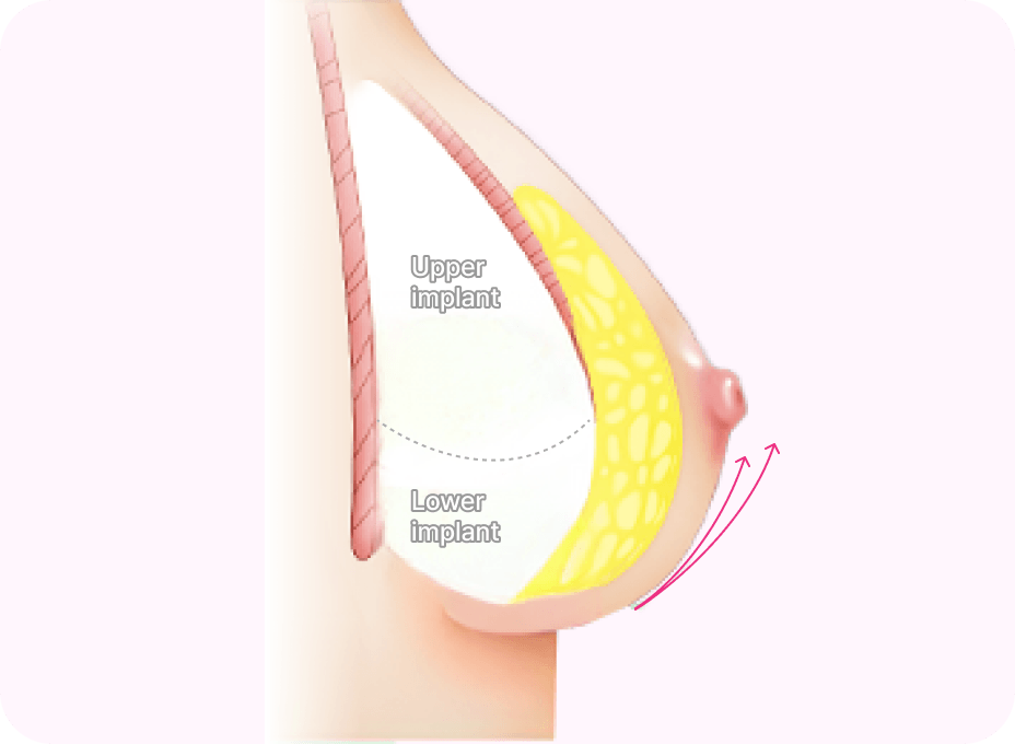 id Hospital - Breast Augmentation After Delivery - Breast Lifting After Surgery