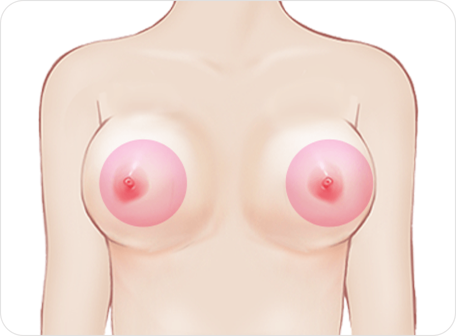 id Hospital - Breast Revision - Capsular Contracture