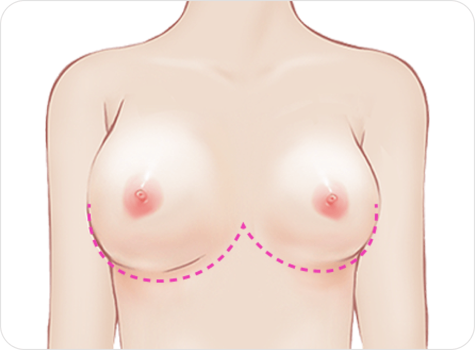 id Hospital - Breast Revision - Shape Deformity