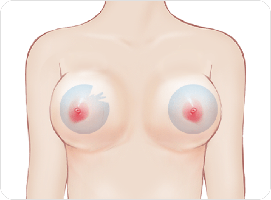 id Hospital - Breast Revision - Implant Damage