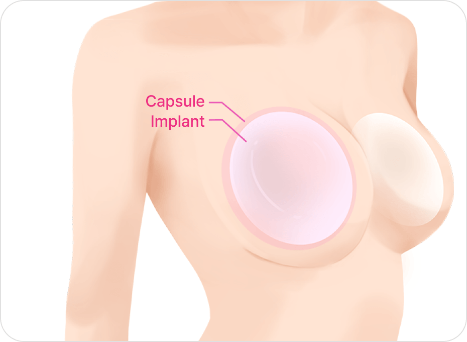 id Hospital - Breast Revision - Complete Capsulectomy