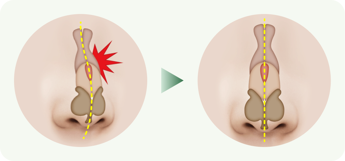 id Hospital - Nasal Fracture Repair - Nasal Bone Fracture Repair at id