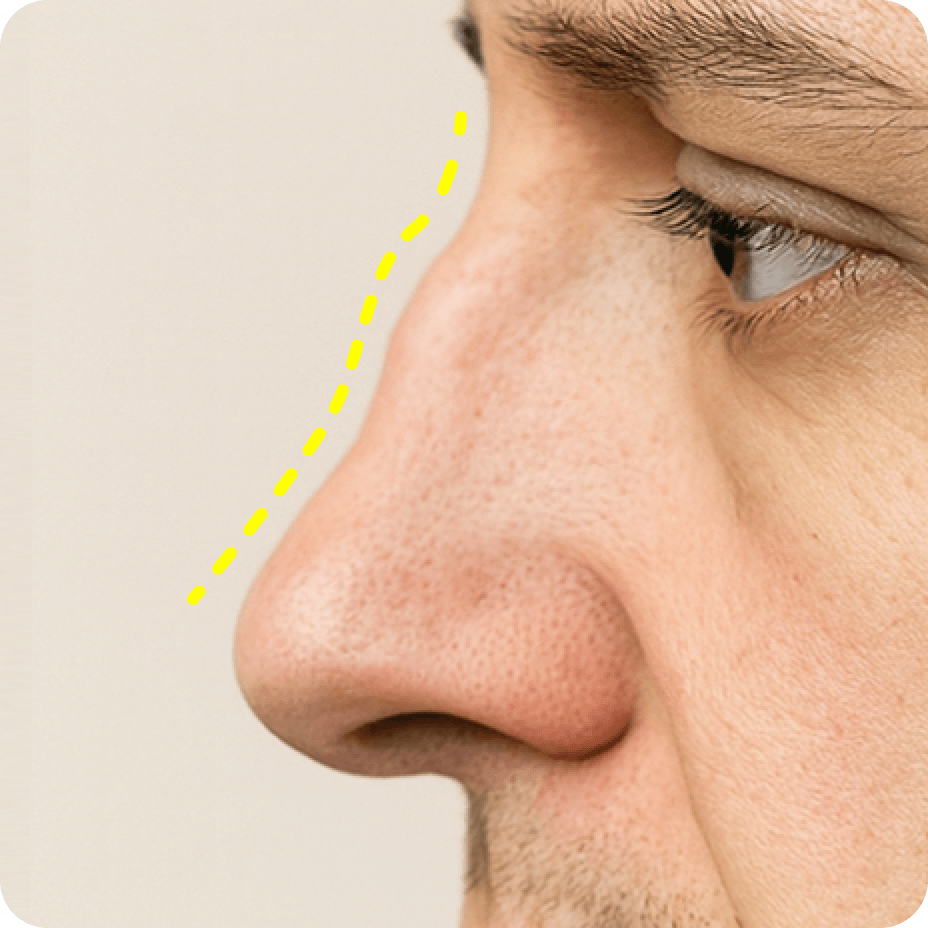 id Hospital - Nasal Fracture Repair - Collapsed nasal bridge with uneven contour