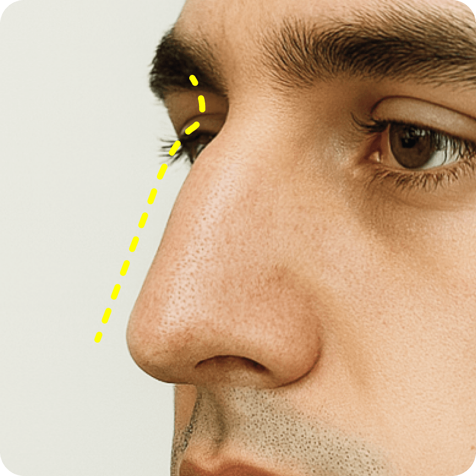 id Hospital - Nasal Fracture Repair - Developed hump nose