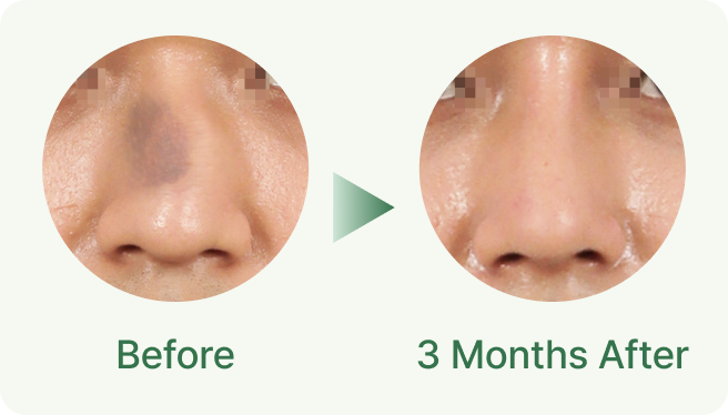 id Hospital - Nasal Fracture Repair - External Appearance Correction