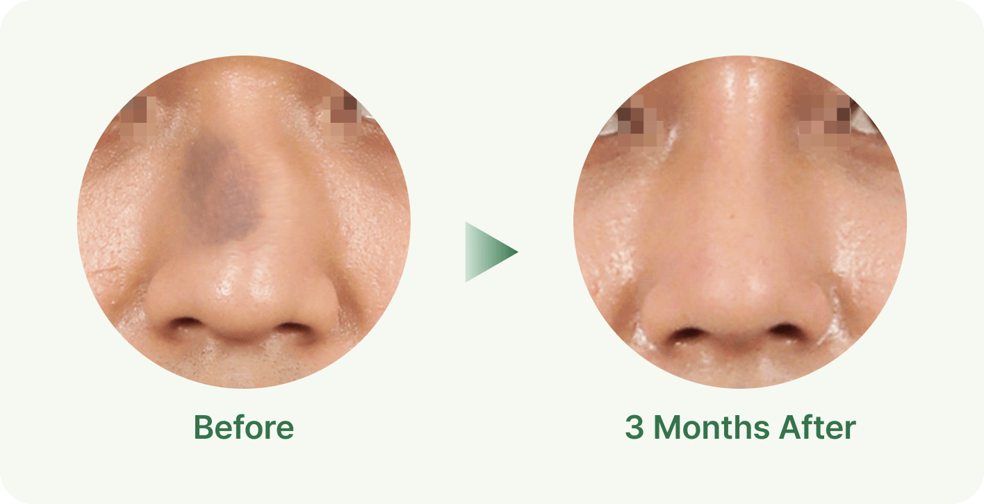 id Hospital - Nasal Fracture Repair - External Appearance Correction