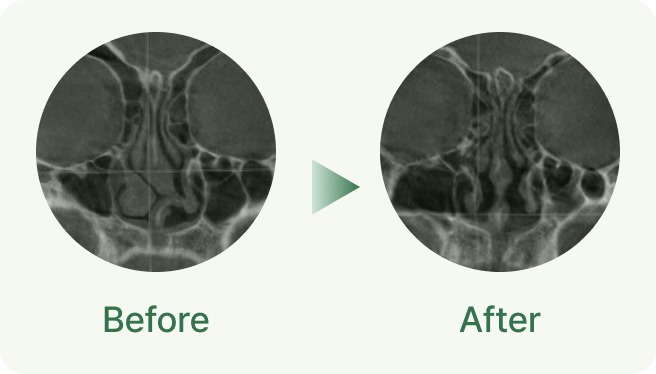 id Hospital - Nasal Fracture Repair - Internal Function Correction