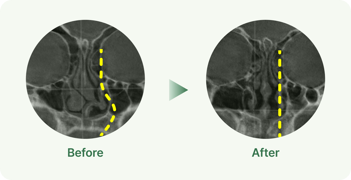 id Hospital - Nasal Fracture Repair - Internal Function Correction