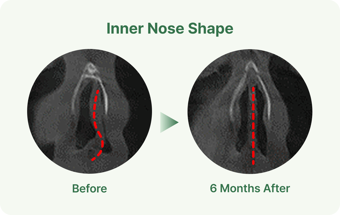 id Hospital - Septoplasty - One-Stop One-Day Straight Nose Line 1