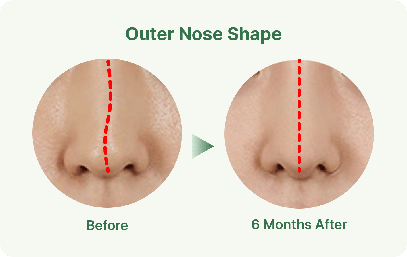 id Hospital - Septoplasty - One-Stop One-Day Straight Nose Line 2