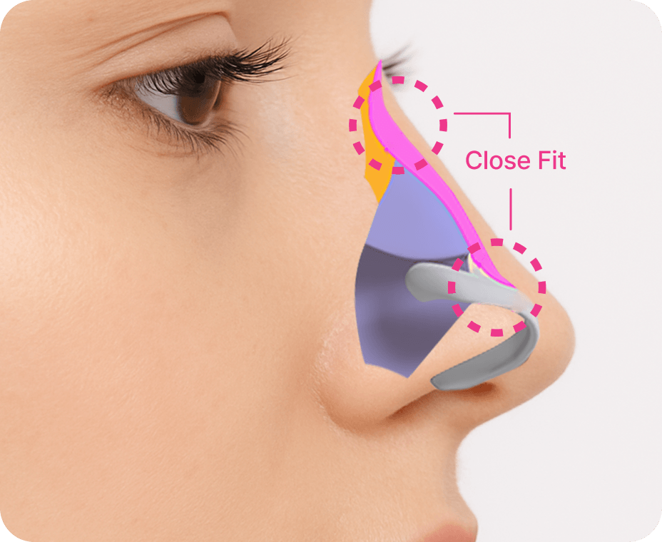 id Hospital - Septoplasty - Perfectly Fitted Nose Implant
