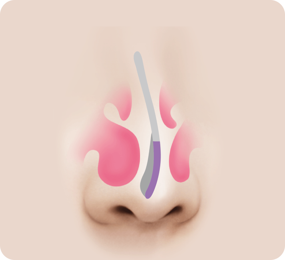 id Hospital - Septoplasty - Hypertrophic Rhinitis Before
