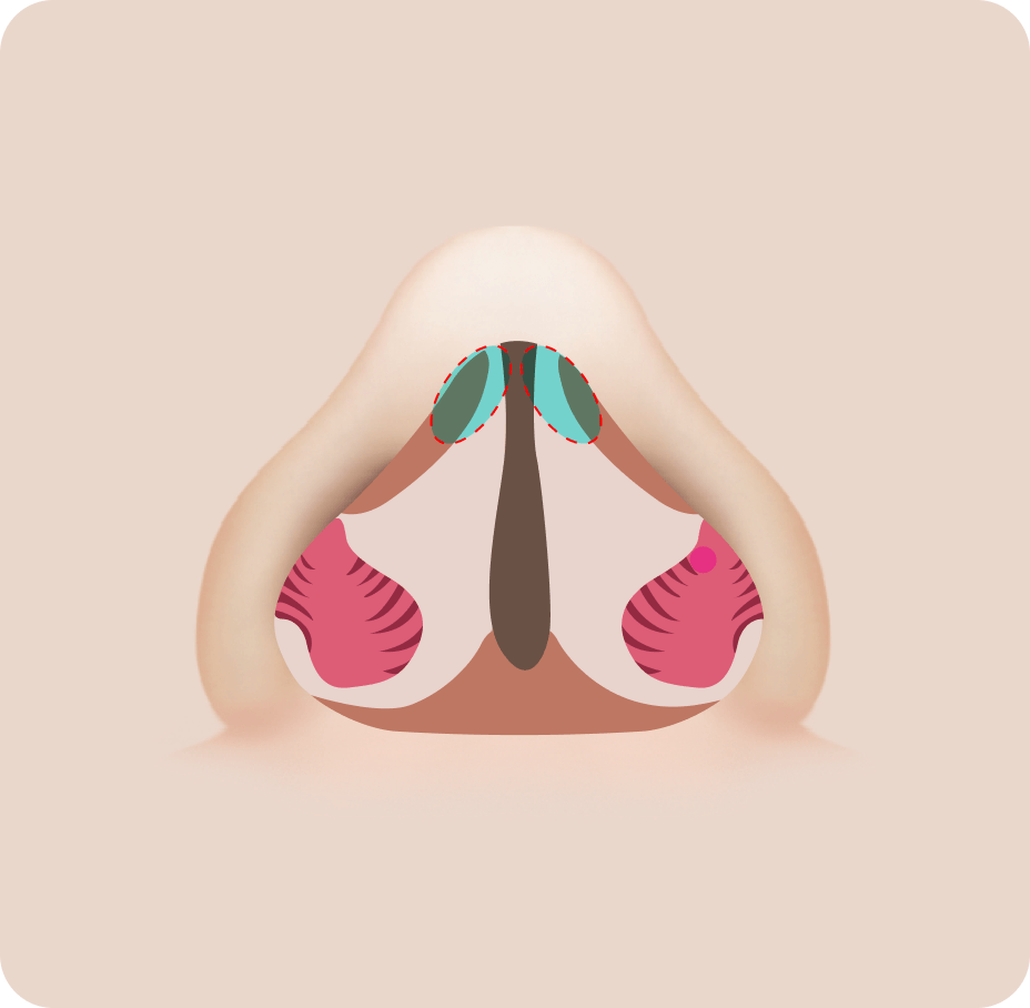 id Hospital - Septoplasty - Nasal Valve Stenosis Before